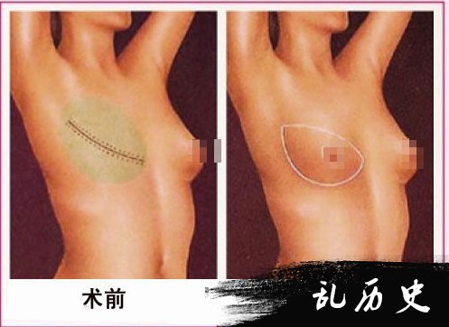重造乳房照片大全 重造乳房怎么做