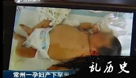 什么是胎中胎?孕妇生下胎中胎