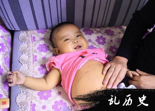 6个月大女婴因病眼睛“变绿” 肚皮肿胀