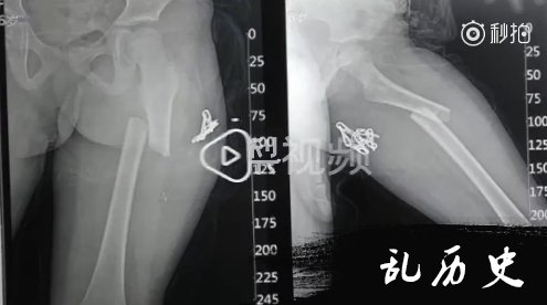 因走路慢被父亲踢断腿