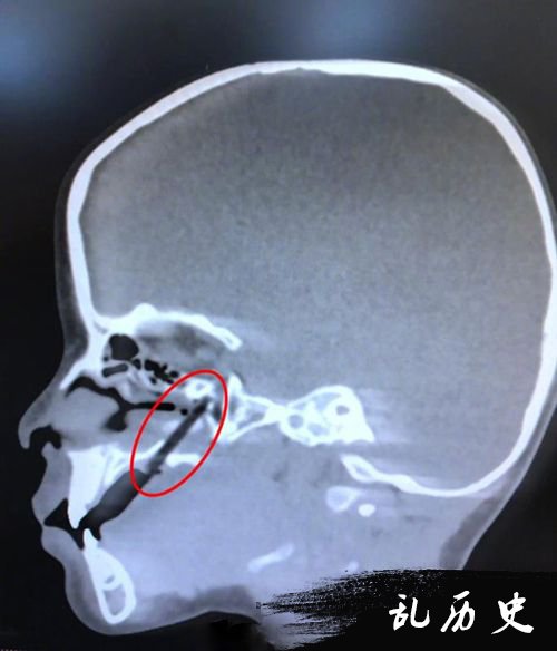 图可见半截筷子插入男童上颚