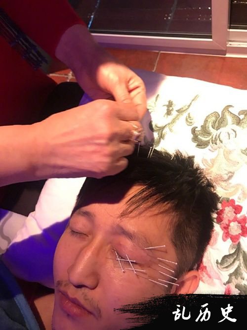 冉莹颖晒邹市明眼疾治疗照 左眼头部插满针引心疼