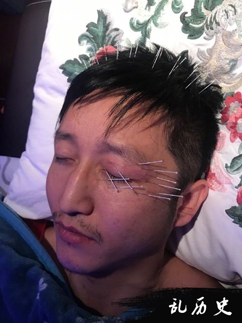 冉莹颖晒邹市明眼疾治疗照 左眼头部插满针引心疼