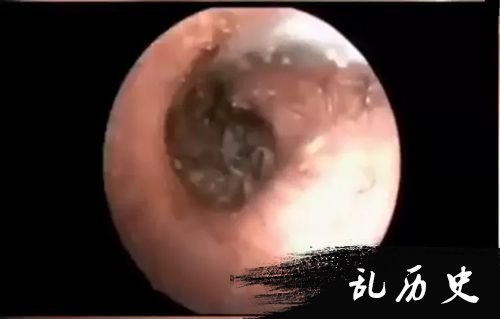 医生在大叔鼻腔深处夹出苍蝇