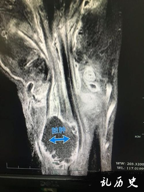 CT显示姚先生手臂脓肿肌腱断裂